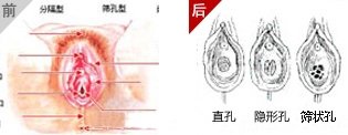 处女膜修复手术前后对比图