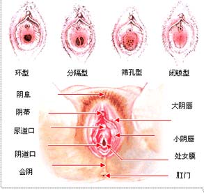 处女膜修复